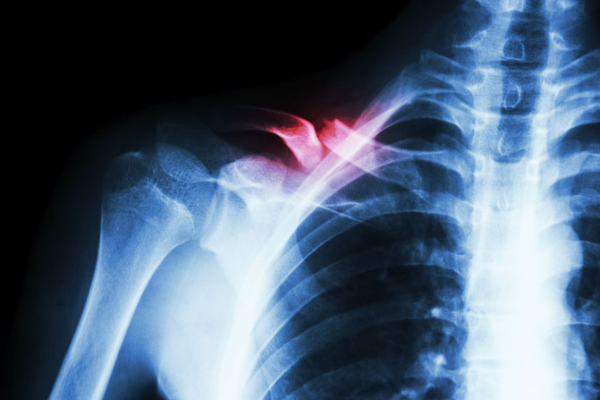 Q A What To Expect After Breaking A Collarbone The Physical 